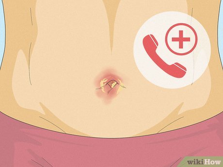 Navel Infection: Symptoms And Treatment - Edition Time